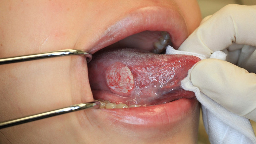 Thumbnail of Early Symptoms of Tongue Cancer are Subtle: Why You Should Get an Oral Examination