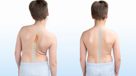 Thumbnail of 3D-Printed Braces: A Lighter, Breathable Solution for Combating Adolescent Scoliosis