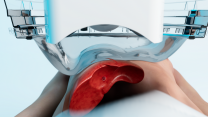 Thumbnail of Histotripsy: Ultrasound Technology that Fragments Liver Cancer Tissue Using Microbubbles – For Primary or Metastatic Liver Cancer