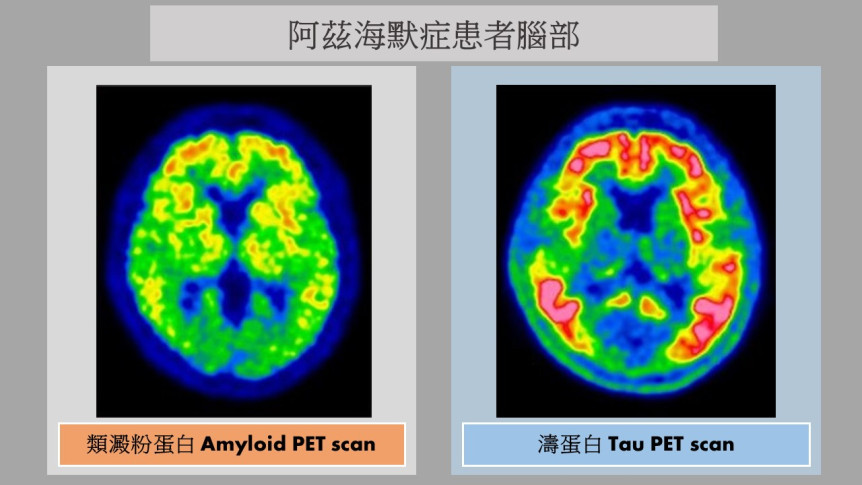 Thumbnail of Dual Tracer PET Scan for Alzheimer's Disease