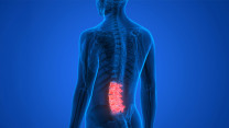 Thumbnail of Understanding Lumbar Spinal Stenosis and Its Treatment