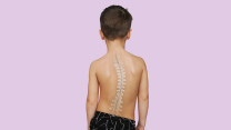 Thumbnail of Surgical and Non-surgical Treatments for Scoliosis