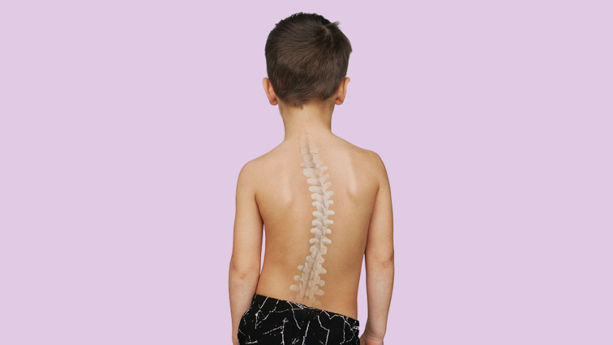 Thumbnail of Surgical and Non-surgical Treatments for Scoliosis