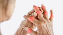 Thumbnail of Wrist and Hand Osteoarthritis: Symptoms, Types and Treatments