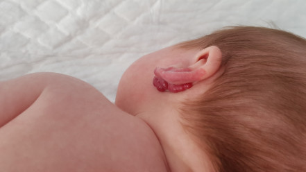 Thumbnail of Infantile Hemangioma: Diagnosis, Treatment and Management