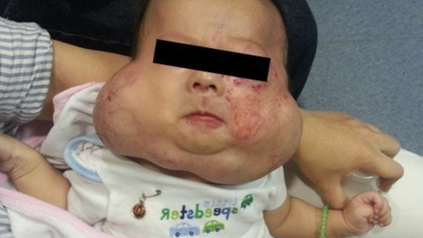 缩图 - 婴儿血管瘤1个典型症状：皮肤红点增大成软瘤  复杂个案或影响发育  早产婴风险较高
