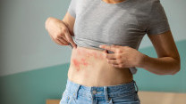 Thumbnail of Common Myths, Prevention and Treatment about Herpes Zoster