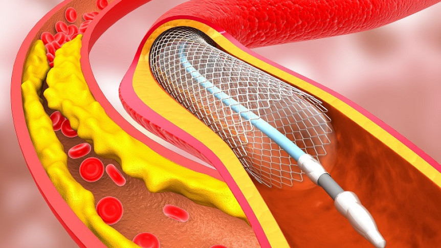 Thumbnail of Angioplasty