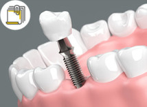 Thumbnail of 5 Essential Considerations Before and After Dental Implant Surgery