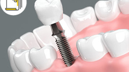 Thumbnail of 5 Essential Considerations Before and After Dental Implant Surgery