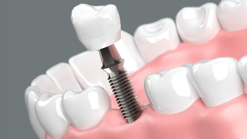 Thumbnail of 5 Essential Considerations Before and After Dental Implant Surgery