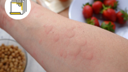 Thumbnail of Food Allergies: From Avoidance to Prevention