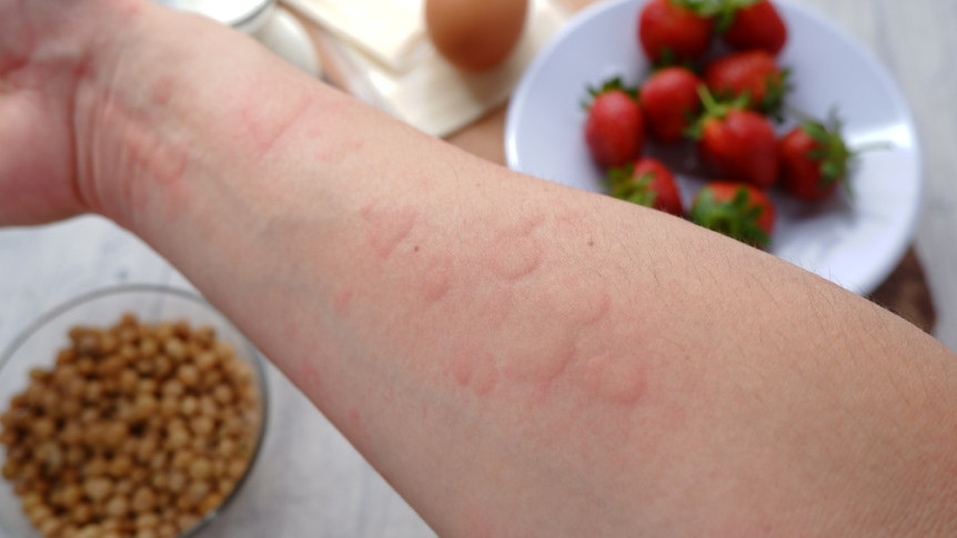 Thumbnail of Food Allergies: From Avoidance to Prevention
