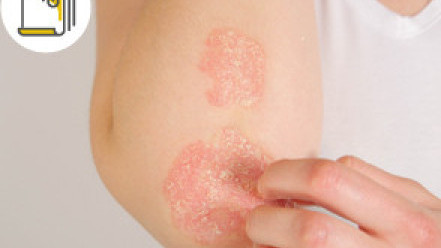 缩图 - 转季湿疹又发作 从头到手脚7个日常护理方法 纾缓皮肤痕痒减恶化机会