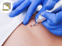 Thumbnail of Warts vs Milia Do Not Remove Warts by Yourself to Avoid Multiple Growth