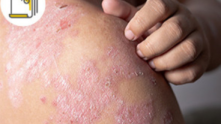 缩图 - 银屑病成因是遗传？皮肤炎症随时影响全身关节发炎 了解生物制剂疗效