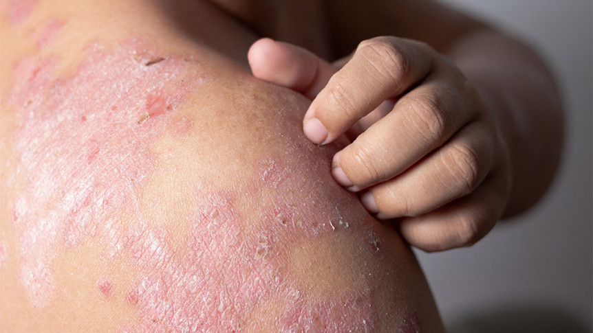 Thumbnail of Causes, Symptoms and Treatment of Psoriasis