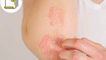 縮圖 - 回南天兩大因素致異位性皮膚炎發作 皮膚痕癢難斷尾?擔心使用類固醇副作用?