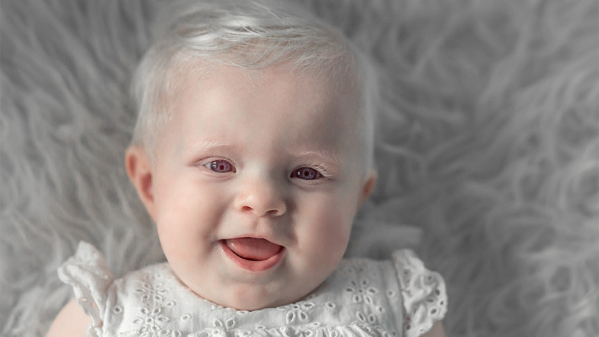Thumbnail of Know More About Albinism