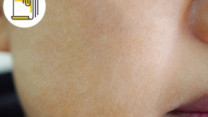 Thumbnail of Tackle 3 Major Skin Problems From a Nutrition Perspective