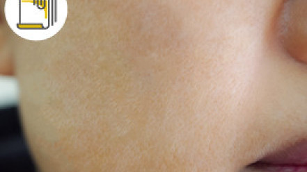 Thumbnail of Tackle 3 Major Skin Problems From a Nutrition Perspective
