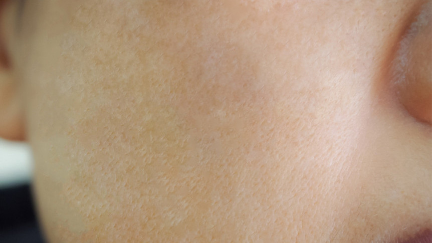 Thumbnail of Tackle 3 Major Skin Problems From a Nutrition Perspective