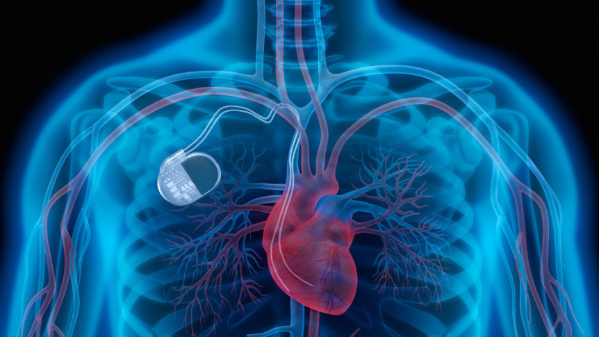 Thumbnail of Functions and Types of Pacemakers