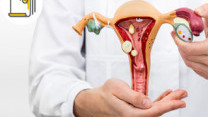 Thumbnail of Treatment of Uterine Fibroids