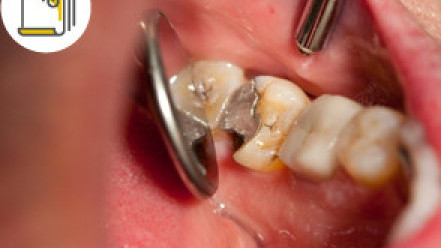 Thumbnail of Learn More About Dental Filling Procedures and Materials