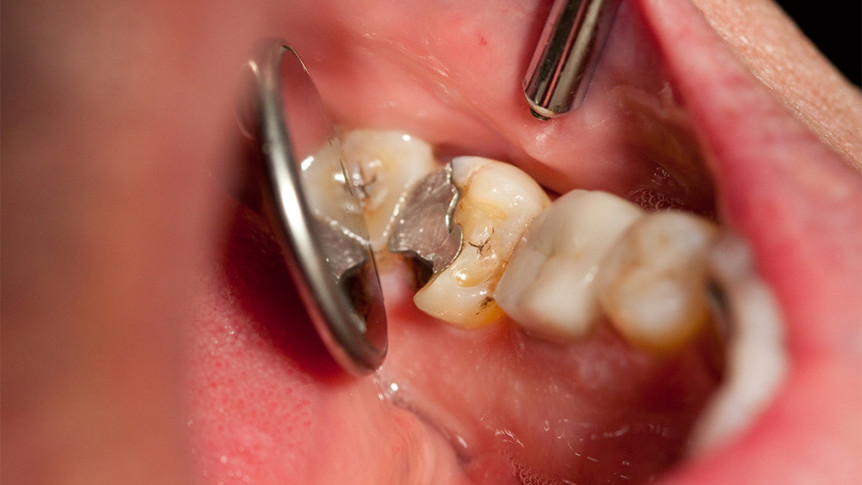 Thumbnail of Learn More About Dental Filling Procedures and Materials