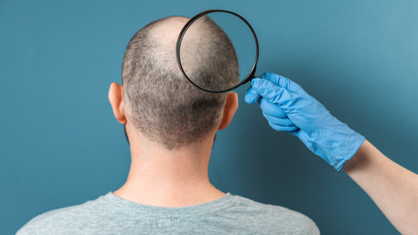 Thumbnail of Hair Loss: Types, Causes and Treatment