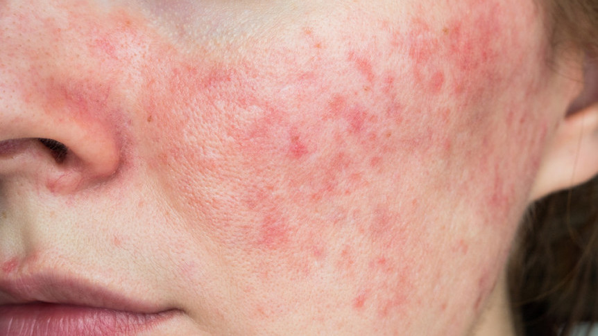 Thumbnail of Early Treatment of Rosacea