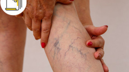 Thumbnail of Symptoms and Treatment of Varicose Vein