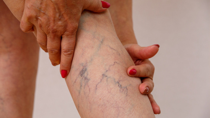 Thumbnail of Symptoms and Treatment of Varicose Vein
