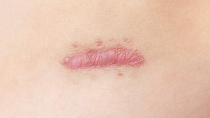 Thumbnail of Dealing with Keloids