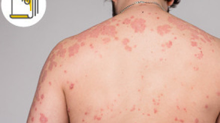 Thumbnail of Eczema vs Urticaria: Causes, Symptoms and Treatment