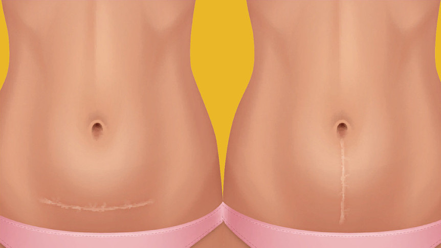 Thumbnail of “Ask Dr. HKSH” Caesarean Scar Management