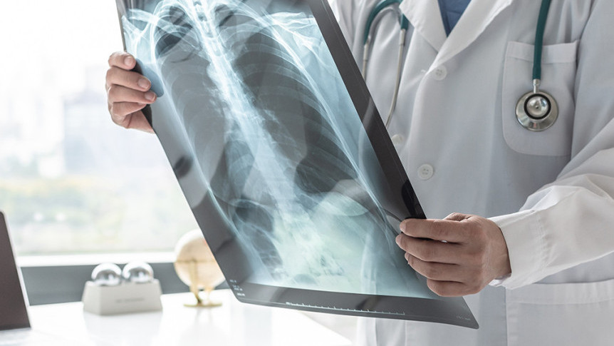 Thumbnail of 5 Major Symptoms of Tuberculosis and Testing Methods