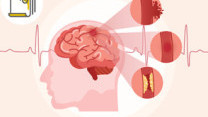 Thumbnail of Acute Stroke: A Matter of Life or Death