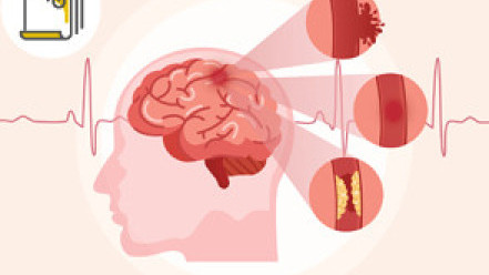 Thumbnail of Acute Stroke: A Matter of Life or Death