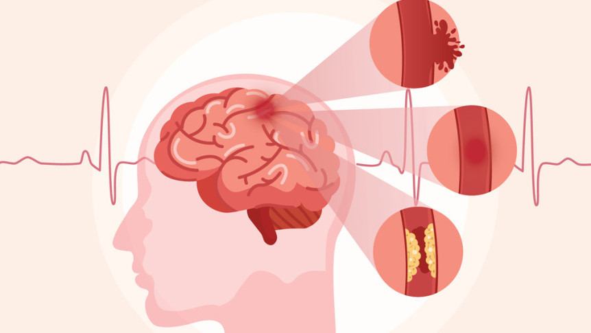 Thumbnail of Acute Stroke: A Matter of Life or Death