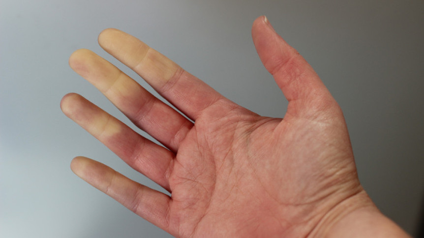 Thumbnail of Raynaud's Phenomenon