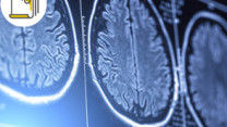 Thumbnail of The Application of AI on Acute Stroke Diagnosis and Assessment