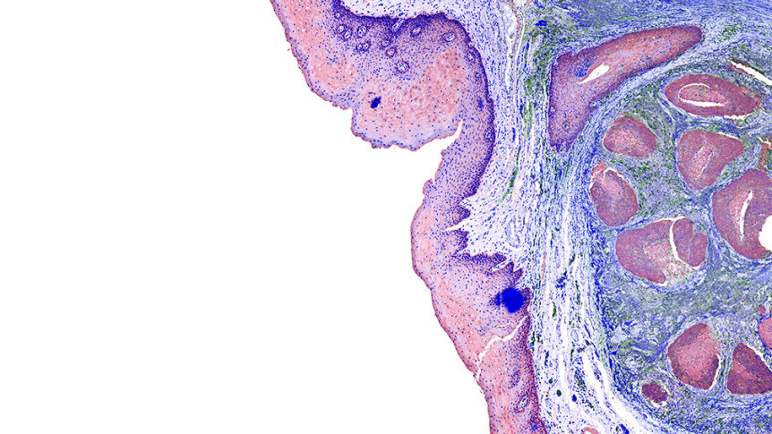 Thumbnail of Lymphoma Staging and Treatment