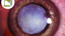 Thumbnail of 5 Questions about Cataract Surgery