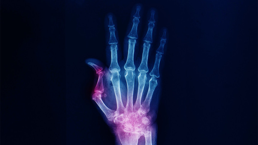 Thumbnail of Rheumatoid Arthritis