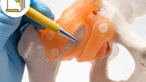 Thumbnail of Robotic-assisted Total Hip Replacement