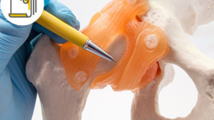 Thumbnail of Robotic-assisted Total Hip Replacement