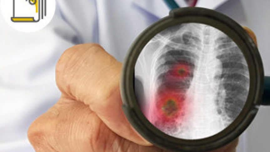 Thumbnail of Common Cancer in Men - Lung Cancer
