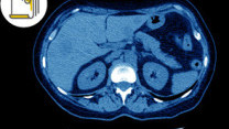 Thumbnail of Use of Dual-tracer (11C-Acetate and 18F-FDG) PET/CT in 90Y Selective Internal Radiation Therapy (SIRT) for Late-stage Liver Cancer